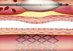 Peripheral Artery Disease: Drug-Coated Balloon vs Percutaneous Transluminal Angioplasty Peripheral Artery Disease: Drug-Coated Balloon vs Percutaneous Transluminal Angioplasty