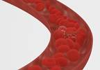 Venous Thromboembolism and Migraine May Share Mechanistic Link Venous Thromboembolism and Migraine May Share Mechanistic Link