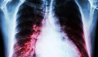 Much improved survival from ART has resulted in increased risks of heart failure associated with HIV and possibly treatment. Much improved survival from ART has resulted in increased risks of heart failure associated with HIV and possibly treatment.
