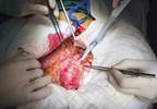 Psoriasis Determined as Risk Factor for Abdominal Aortic Aneurysms Psoriasis Determined as Risk Factor for Abdominal Aortic Aneurysms