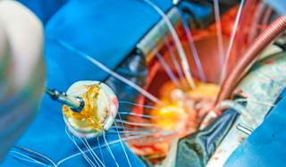 Positive hemodynamics changes were seen in patients with heart failure after receiving TAVR or SAVR. Positive hemodynamics changes were seen in patients with heart failure after receiving TAVR or SAVR.