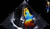 Imaging for Heart Failure Prevention in Diabetes Patients May Be Cost-Effective Imaging for Heart Failure Prevention in Diabetes Patients May Be Cost-Effective