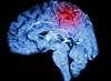 Pediatric Stroke Patients Often Complain of Headache Pediatric Stroke Patients Often Complain of Headache
