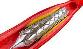 At index PCI, 7.1% of patients had a diagnosis of AF At index PCI, 7.1% of patients had a diagnosis of AF