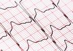 After Stroke Onset, Prehospital ECG Helps Detect Atrial Fibrillation After Stroke Onset, Prehospital ECG Helps Detect Atrial Fibrillation