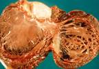 Managing Cardiovascular Complications of Oncology Treatment Managing Cardiovascular Complications of Oncology Treatment