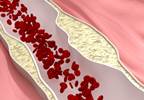 VIDEO: Alirocumab Reduced Use of Apheresis VIDEO: Alirocumab Reduced Use of Apheresis