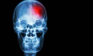 Both acute ischemic stroke and stroke risk factors are on the rise among Americans younger than 65 years of age. Both acute ischemic stroke and stroke risk factors are on the rise among Americans younger than 65 years of age.