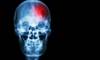 Black-White Stroke Mortality Disparity Tied to Differences in Stroke Incidence Black-White Stroke Mortality Disparity Tied to Differences in Stroke Incidence