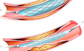 No major differences in MACE or stent thrombosis were shown between the 2 drug-eluting stents after 10 years of follow-up. No major differences in MACE or stent thrombosis were shown between the 2 drug-eluting stents after 10 years of follow-up.