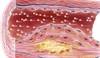 AACE, ACE Dyslipidemia Clinical Practice Guidelines Update AACE, ACE Dyslipidemia Clinical Practice Guidelines Update