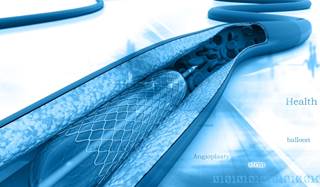 None of the patients who received everolimus-eluting stents had very late stent thrombosis. None of the patients who received everolimus-eluting stents had very late stent thrombosis.