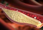 Incident CHD Risk Elevated With High Triglycerides, Low HDL Incident CHD Risk Elevated With High Triglycerides, Low HDL