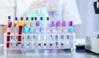 Swedish study shows how protein profiling with a multiplex assay can enhance kidney disease research. Swedish study shows how protein profiling with a multiplex assay can enhance kidney disease research.
