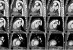 Non-Coronary Measures May Improve Prognostic Value of Cardiac Computed Tomography Non-Coronary Measures May Improve Prognostic Value of Cardiac Computed Tomography