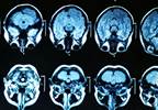 Filter Device Protects Against Brain Injury in TAVI Filter Device Protects Against Brain Injury in TAVI