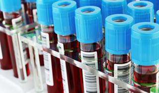 Canagliflozin delayed the rise in NT-proBNP and hsTnI for over 2 years in older type 2 diabetes patients patients. Canagliflozin delayed the rise in NT-proBNP and hsTnI for over 2 years in older type 2 diabetes patients patients.