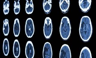After 90 days, researchers found no significant differences in mortality rates and disability between the 2 groups. After 90 days, researchers found no significant differences in mortality rates and disability between the 2 groups.
