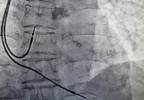 Lead Abandonment Outcomes in Patients With Cardiac Devices Lead Abandonment Outcomes in Patients With Cardiac Devices