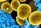 High Rates of Infective Endocarditis Found Among ESRD Patients High Rates of Infective Endocarditis Found Among ESRD Patients