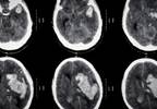 Oral Anticoagulants After Intracranial Hemorrhage Reduced Mortality Risk in Afib Oral Anticoagulants After Intracranial Hemorrhage Reduced Mortality Risk in Afib