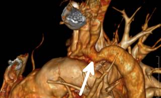 More than 3000 adults with congenital heart disease were classified by BMI (underweight, normal weight, overweight, and obese). More than 3000 adults with congenital heart disease were classified by BMI (underweight, normal weight, overweight, and obese).