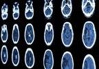Treating Urinary Incontinence Following Stroke Treating Urinary Incontinence Following Stroke