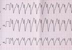 Short Episodes of Tachycardia, AFib Have Little to No Effect on Stroke Risk Short Episodes of Tachycardia, AFib Have Little to No Effect on Stroke Risk