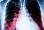 Comorbid Congestive Heart Failure Linked to Worse Outcomes When Receiving Parenteral Nutrition Comorbid Congestive Heart Failure Linked to Worse Outcomes When Receiving Parenteral Nutrition