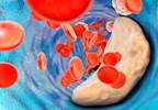 Coronary Artery Calcification Increases Ischemic Risk in Women After PCI Coronary Artery Calcification Increases Ischemic Risk in Women After PCI