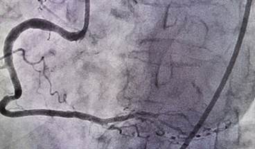 Cardiac Imaging in Suspected Coronary Artery Disease Cardiac Imaging in Suspected Coronary Artery Disease