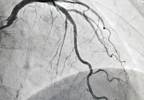 Instantaneous Wave-Free Ratio Noninferior to Fractional Flow Reserve for Guiding PCI Instantaneous Wave-Free Ratio Noninferior to Fractional Flow Reserve for Guiding PCI