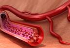 Kidney Transplant Recipients Often Hospitalized With Acute MI Kidney Transplant Recipients Often Hospitalized With Acute MI