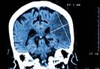Glyburide Offers Hope for Acute Ischemic Stroke Treatment Glyburide Offers Hope for Acute Ischemic Stroke Treatment