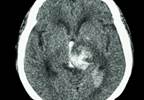 Weighing Benefits and Risks of Anticoagulation in the Elderly Weighing Benefits and Risks of Anticoagulation in the Elderly