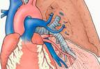LAA Isolation Increases Arrhythmia-Free Interval Post-Catheter Ablation LAA Isolation Increases Arrhythmia-Free Interval Post-Catheter Ablation