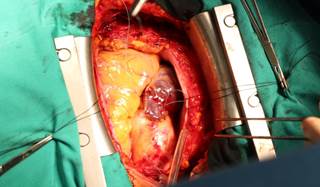Examining CABG vs PCI for multivessel revascularization in type 1 diabetes. Examining CABG vs PCI for multivessel revascularization in type 1 diabetes.