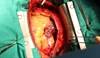 Choosing Between PCI and Surgery for Left Main Coronary Artery Disease Choosing Between PCI and Surgery for Left Main Coronary Artery Disease