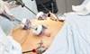 Heart Failure Risk Decreased With Bariatric Surgery Heart Failure Risk Decreased With Bariatric Surgery