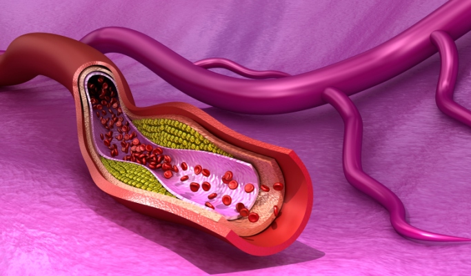 peripheral-arterial-disease-diagnosis-and-management-updates-the