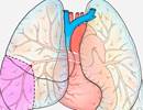 Anatomic Location of Thrombus Not Affected Outcomes of Surgical Pulmonary Embolectomy Anatomic Location of Thrombus Not Affected Outcomes of Surgical Pulmonary Embolectomy