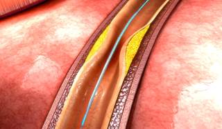 Diabetes, acute MI, and history of CABG were among the predictors of incidence and early time to TLF. Diabetes, acute MI, and history of CABG were among the predictors of incidence and early time to TLF.