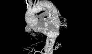 Two cases of postpartum aortic dissection occurred: one type A and one type B. Two cases of postpartum aortic dissection occurred: one type A and one type B.