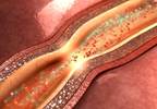 High-Risk Coronary Plaque Detection by CTA in Chest Pain May Predict MACE High-Risk Coronary Plaque Detection by CTA in Chest Pain May Predict MACE