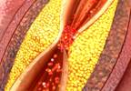 PCI and CABG Provide Similar Intermediate-Term Outcomes in Left Main CAD PCI and CABG Provide Similar Intermediate-Term Outcomes in Left Main CAD