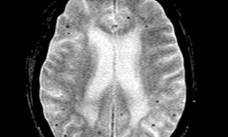 Silent cerebrovascular disease appears to increase the risk for future symptomatic stroke. Silent cerebrovascular disease appears to increase the risk for future symptomatic stroke.