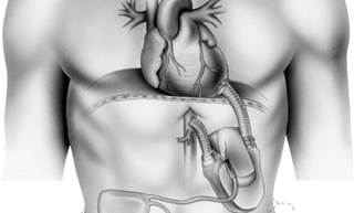Following LVAD explantation, 38% of participants had heart function equivalent to a healthy man. Following LVAD explantation, 38% of participants had heart function equivalent to a healthy man.
