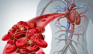 Patients with giant cell arteritis were more likely to experience VTE during the first 3 months following diagnosis. Patients with giant cell arteritis were more likely to experience VTE during the first 3 months following diagnosis.