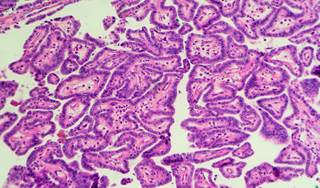 Patients who survive thyroid cancer are more likely to develop heart valve disorders as well as hypertension and cardiac arrhythmias. Patients who survive thyroid cancer are more likely to develop heart valve disorders as well as hypertension and cardiac arrhythmias.