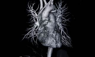 PAH is divided into 3 types: heritable, idiopathic, and PAH linked with various systemic diseases or drug exposure. PAH is divided into 3 types: heritable, idiopathic, and PAH linked with various systemic diseases or drug exposure.